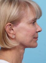 Face Lift/ Neck Lift