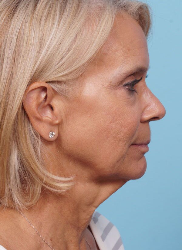 Face Lift/ Neck Lift