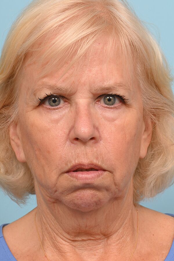 Face Lift/ Neck Lift