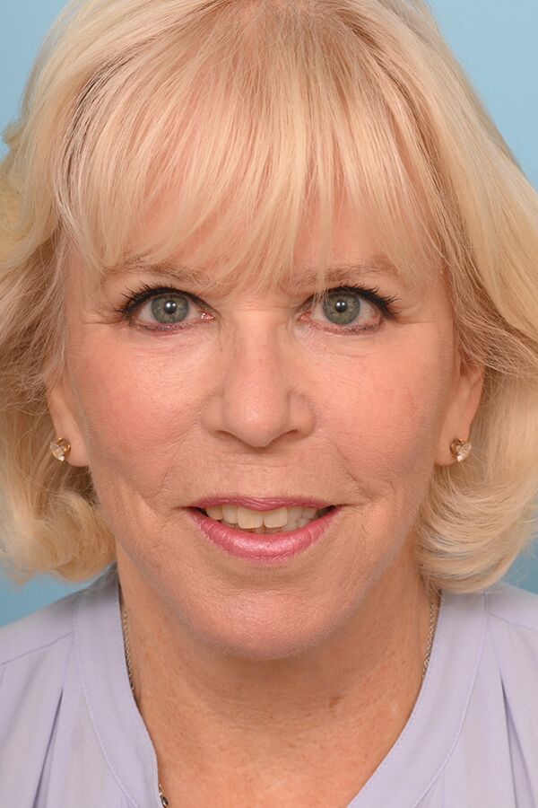Face Lift/ Neck Lift