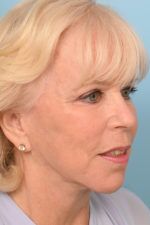 Face Lift/ Neck Lift