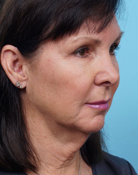 Face Lift/ Neck Lift