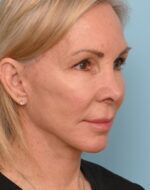 Face Lift/ Neck Lift