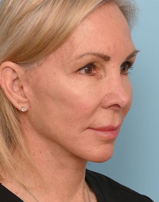Face Lift/ Neck Lift