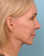Face Lift/ Neck Lift