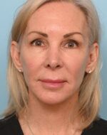 Face Lift/ Neck Lift