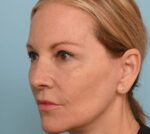 Rhinoplasty