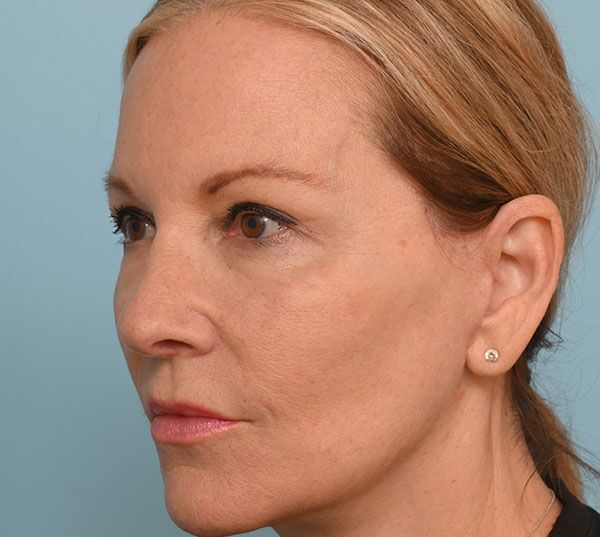Rhinoplasty
