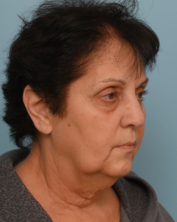 Facial Fat Transfer