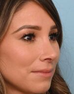 Rhinoplasty