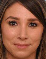Rhinoplasty