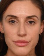 Rhinoplasty