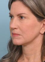Face Lift/ Neck Lift