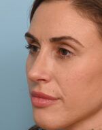 Rhinoplasty