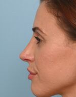 Rhinoplasty