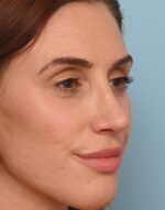 Rhinoplasty
