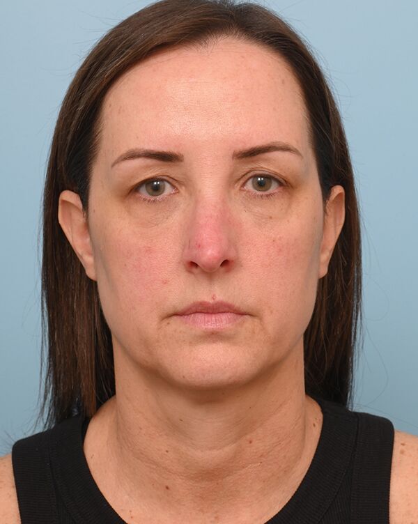 Facial Fat Transfer