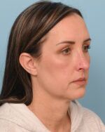 Facial Fat Transfer